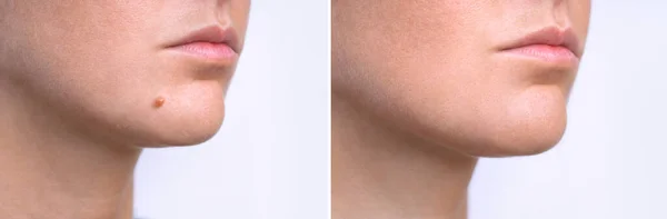 Woman face before and after mole removal. Laser treatment for birthmark removal from patients face. — Stock Photo, Image