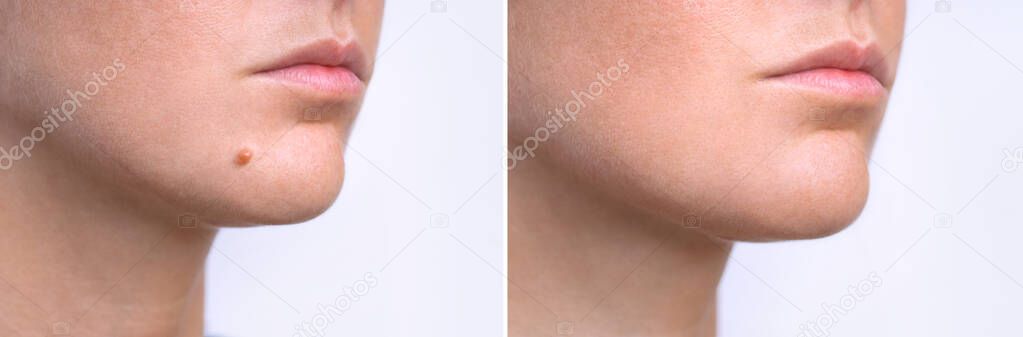 Woman face before and after mole removal. Laser treatment for birthmark removal from patients face.