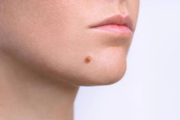 Mole on face. Young woman face with birthmark or nevus. Copy space — Stock Photo, Image