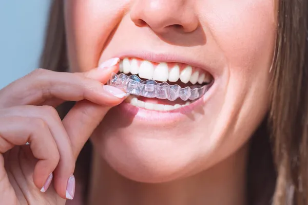 Woman with perfect smile wearing invisible dental aligners for dental correction — Stock Photo, Image