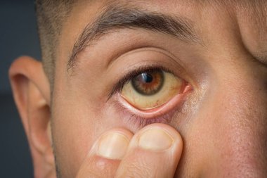 Hasta adam yüksek bilirubin seviyesi, siroz veya hepatit nedeniyle sarı gözleri kontrol ediyor. Karaciğer hastalığı, karaciğer sorunları veya sarılık