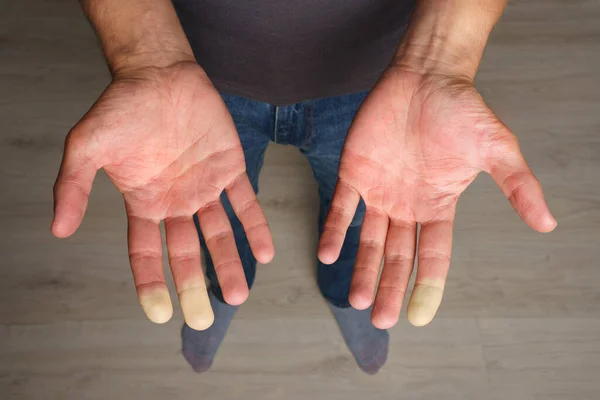 Homem mostrando as mãos com síndrome de Raynaud, fenômeno de Raynauds ou doença de Raynauds — Fotografia de Stock