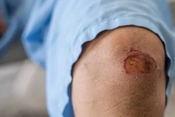 The young man\'s knee wound healed after a motorcycle accident left his knee before being hospitalized until the wound and injuries began to heal with good care from doctors.