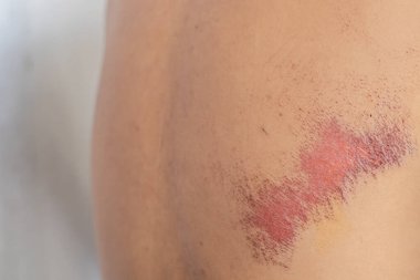 Motosiklet kazasından sonra iyileşen genç adamın vücudundaki yaralar vücudunda yaralar bıraktı ve yaralar iyileşene kadar hastaneye kaldırıldı..