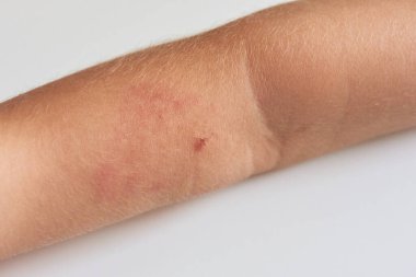 Insect bite on arm of child with allergic reaction