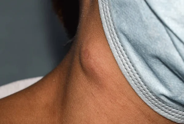 Single swelling or lymph node at the neck of Asian woman.