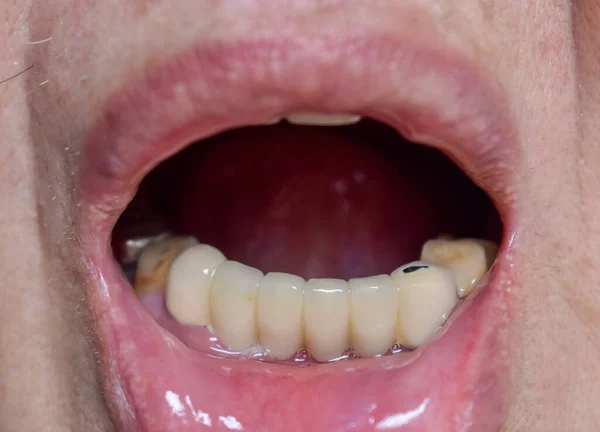 Zirconia Κορώνες Των Μπροστινών Δοντιών Στην Ασιατική Γέρος — Φωτογραφία Αρχείου