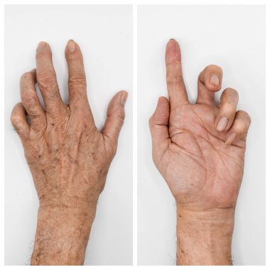 Ulnar claw hand of Asian elder man. also known as 'spinster's claw. develops due to ulnar nerve damage causing paralysis of the lumbricals. clipart