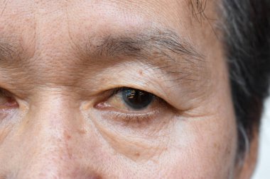 Skin creases around the eye of Asian elder man showing aging.  clipart