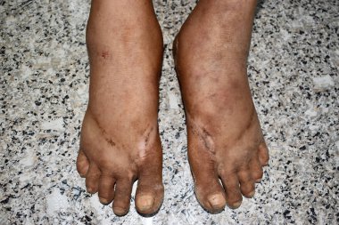 Alt uzuvlarda çift taraflı ödem. Asyalı kadının bacağı ve ayağı şişti..