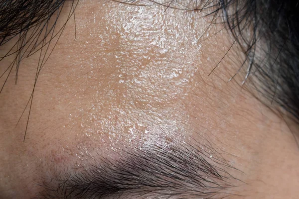 Excessive sweating or hyperhidrosis and oily skin at forehead of Southeast Asian, Myanmar or Chinese adult young man. Oily skin is the result of overproduction of sebum from sebaceous glands.