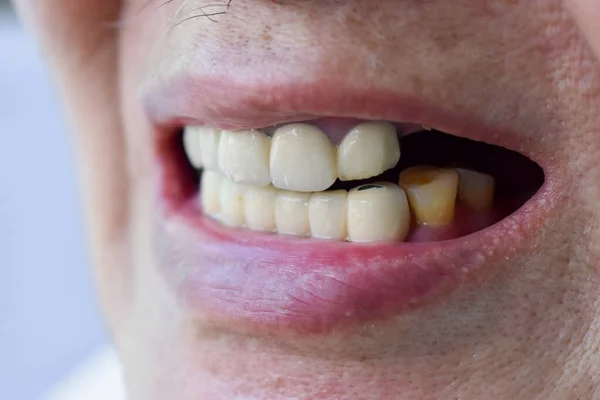 アジアの老人の前の歯のジルコニアクラウン — ストック写真