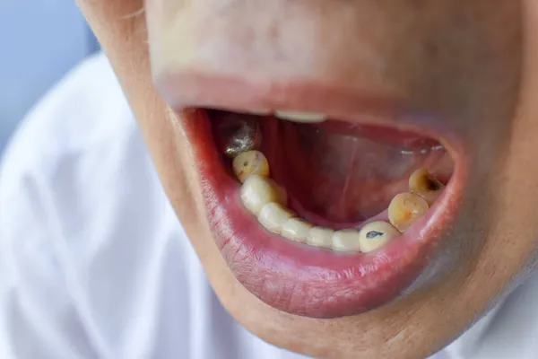 アジアの老人の前の歯のジルコニアクラウン — ストック写真