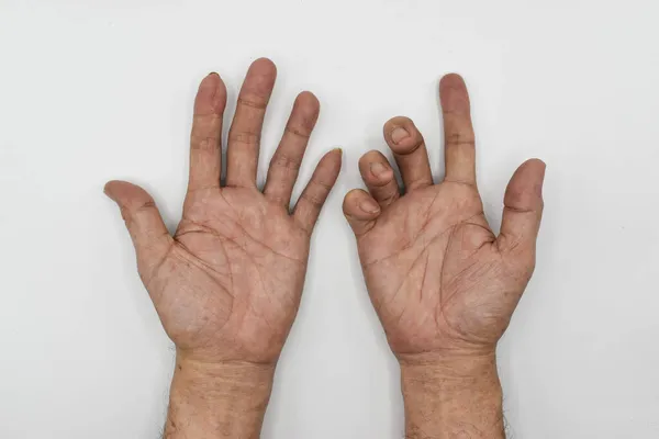 Ulnar claw hand compared to normal hand of Asian old man. also known as \'spinster\'s claw. develops due to ulnar nerve damage causing weakness of the lumbricals.