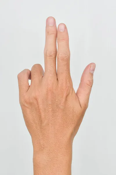 Eenzijdige Dupuytren Contractuur Bij Aziatische Jongeman Eenzijdige Hand Abnormaliteit Abnormale — Stockfoto