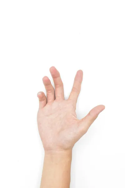 Unilateral Dupuytren Contracture Asian Young Man Unilateral Hand Abnormality Abnormal — Stock Photo, Image