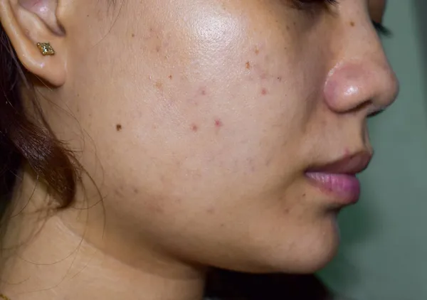 Chloasma Vagy Melasma Fekete Foltok Akne Hegek Ázsiai Fiatal Arcán — Stock Fotó