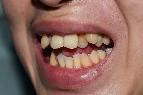 아시아인 의노란 얼룩이 있거나 찌그러진 이빨이야 이빨이라고 불리기도 합니다 — 스톡 사진
