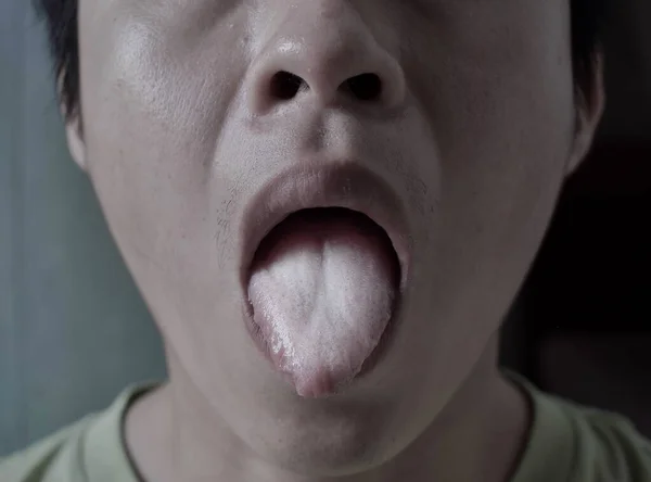 亚洲人或中国人的涂有油漆的舌头或白舌 当碎屑 细菌和死亡细胞嵌入到扩大的乳头之间时 就会出现白色层 丧失味觉 叫失语症 — 图库照片