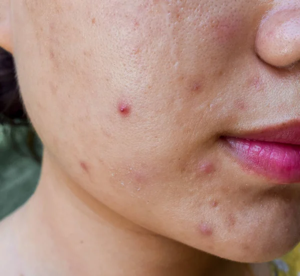 Acné Manchas Negras Cicatrices Cara Grasa Mujer Joven Asiática —  Fotos de Stock