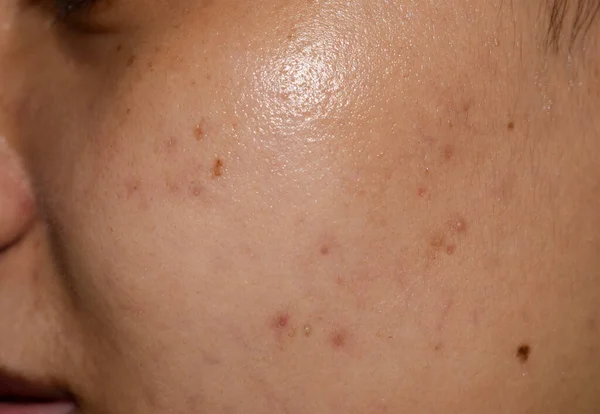 Chloasma Melasma Black Spots Acne Scars Asian Young Woman — Stock Photo, Image