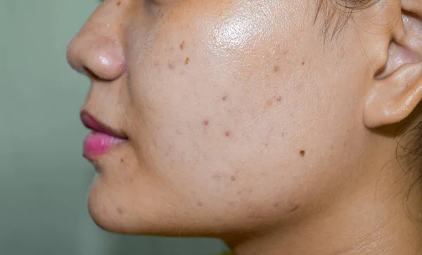 Chloasma Vagy Melasma Fekete Foltok Akne Hegek Ázsiai Fiatal — Stock Fotó