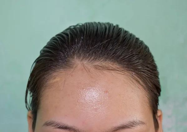 Oily skin and pimples on wide forehead of Southeast Asian, Myanmar or Korean adult young woman.