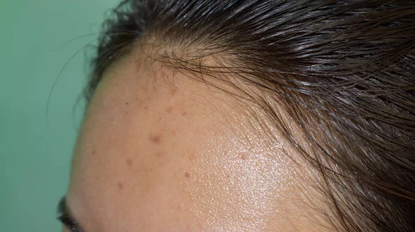 Acne Manchas Pretas Cicatrizes Testa Jovem Mulher Asiática — Fotografia de Stock
