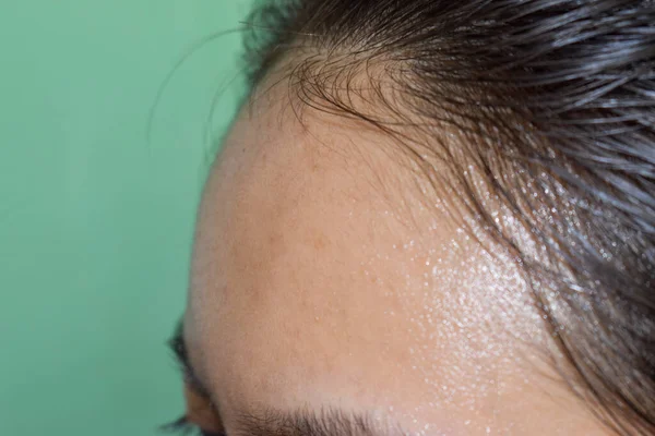 Oily skin and pimples on wide forehead of Southeast Asian, Myanmar or Korean adult young woman.