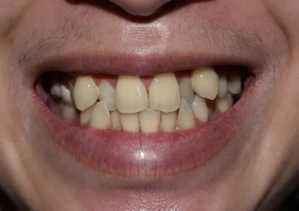 Stacked or overlapping teeth with yellow stain of Asian man. Also called crowded teeth.