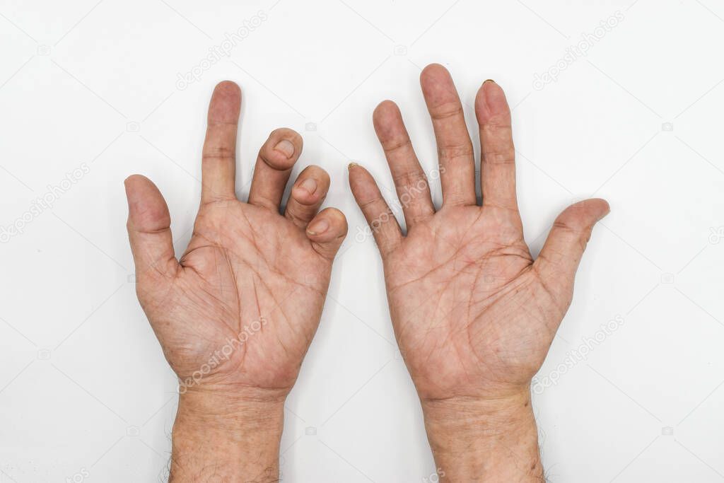 Ulnar claw hand compared to normal hand of Asian old man. also known as 'spinster's claw. develops due to ulnar nerve damage causing paralysis of the lumbricals.
