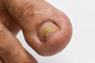 Ayak tırnağı zedelenmiş. Mantar tırnağı enfeksiyonu. Onychomycosis, ayrıca Tinea unguium olarak da bilinir..