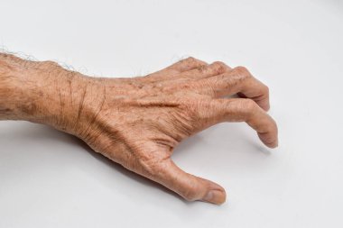 Güneydoğu Asyalı yaşlı adamın sol üst dalında Volkmann kasılmaları var. El, el, parmak ve bilek gibi pençe oluşmasını sağlayan ön kol kaslarının sürekli kısalmasıdır..