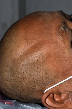 Swelling in temporal region of head. Scalp internal haemorrhage.