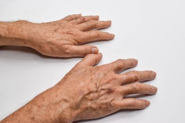 Asyalı yaşlı adamın ellerinde yaş lekeleri var. Bunlar kahverengi, gri veya siyah noktalardır ve ayrıca karaciğer lekeleri, bunak mercimek, güneş mercimeği veya güneş lekeleri olarak da adlandırılır..