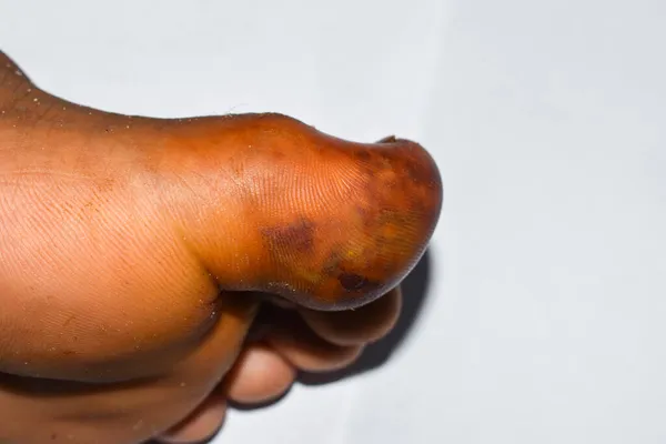 Abscess Surrounding Cellulitis Staphylococcal Streptococcal Skin Infection Big Toe Asian — Stock Photo, Image