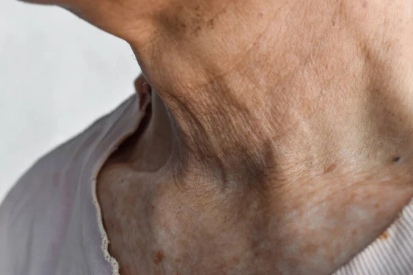 Γήρανση Του Δέρματος Πτυχώσεις Ρυτίδες Του Δέρματος Στο Λαιμό Της — Φωτογραφία Αρχείου