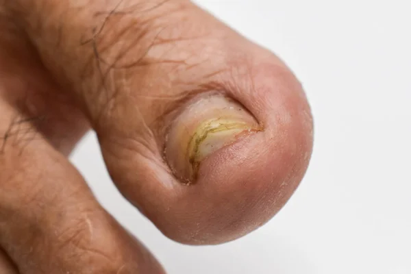 Поврежденный Ноготь Грибковая Инфекция Ногтей Онихомикоз Называемый Tinea Unguium — стоковое фото