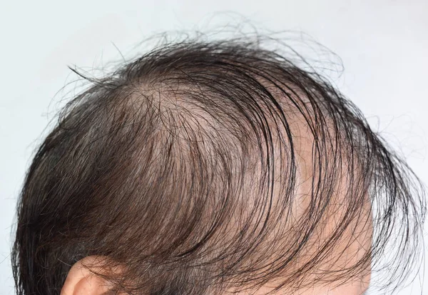 Thinning or sparse hair, male pattern hair loss in Southeast Asian, Chinese elder man.