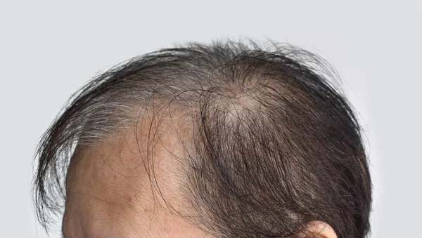 Dünnes Oder Spärliches Haar Männlicher Haarausfall Südostasien Chinesischer Älterer Mann — Stockfoto