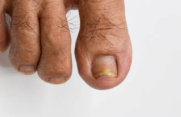 受伤的脚趾甲 真菌指甲感染 单胞菌病 又称单胞菌病 — 图库照片