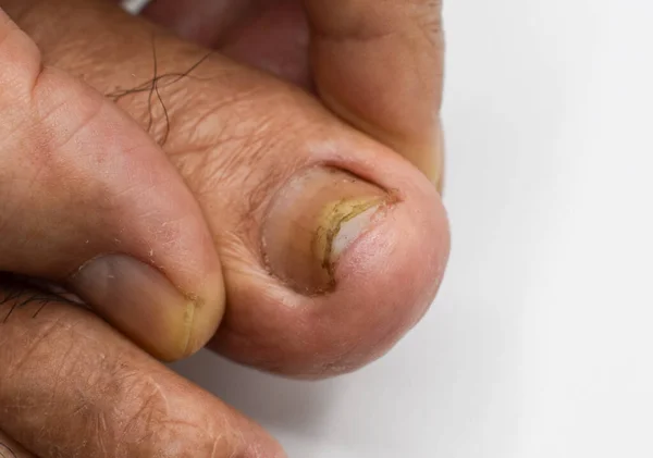 Κατεστραμμένο Νύχι Ποδιού Μυκητιασική Λοίμωξη Onychomycosis Επίσης Ονομάζεται Tinea Unguium — Φωτογραφία Αρχείου