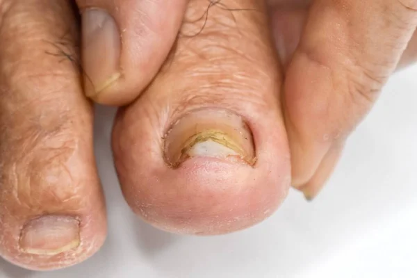Beschädigter Fußnagel Nagelpilzbefall Onychomykose Auch Tinea Unguium Genannt — Stockfoto