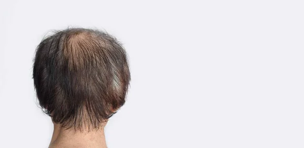 Adelgazamiento Pelo Escaso Pérdida Cabello Patrón Masculino Sudeste Asiático Hombre — Foto de Stock