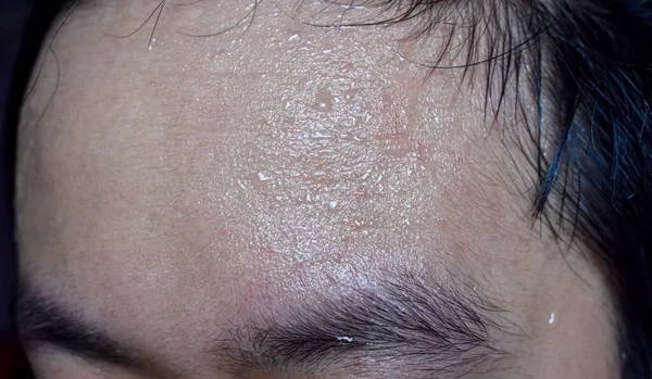 Excessive sweating or hyperhidrosis and oily skin at forehead of Southeast Asian, Myanmar or Chinese adult young man. Oily skin is the result of overproduction of sebum from sebaceous glands.