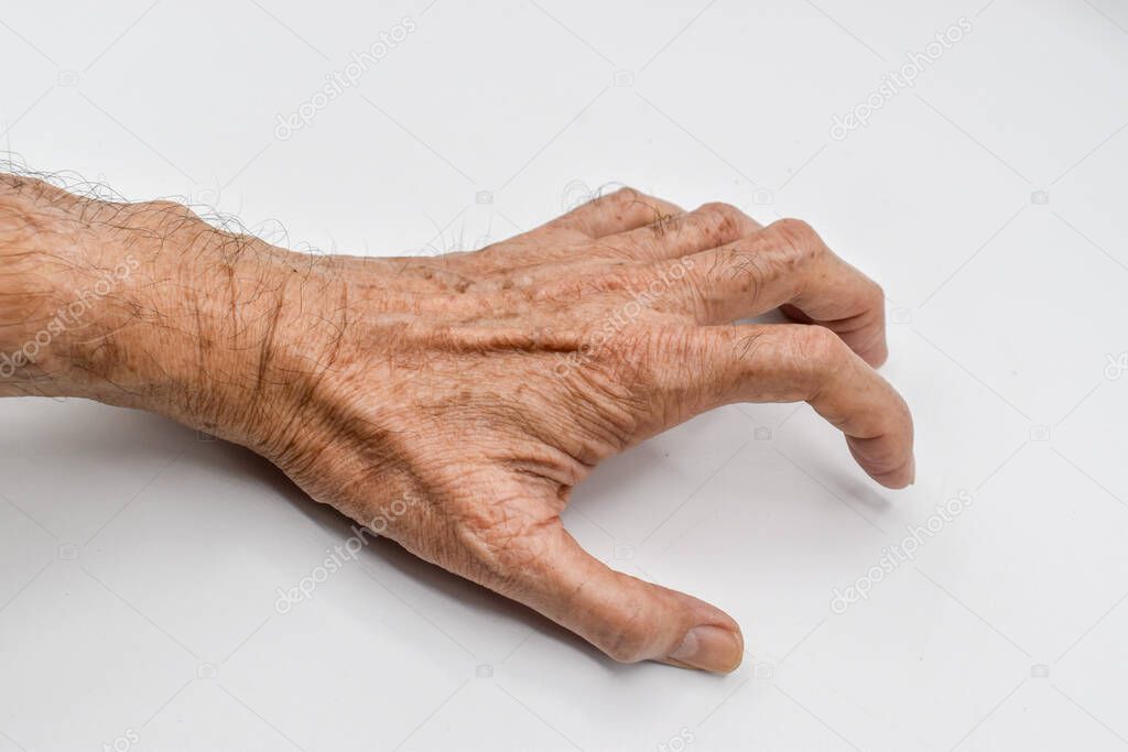Volkmanns contracture in left upper limb of Southeast Asian elder man. It is a permanent shortening of forearm muscles that gives rise to a claw like posture of the hand, fingers, and wrist.