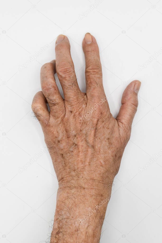 Ulnar claw hand of Asian elder man. also known as 'spinster's claw. develops due to ulnar nerve damage causing paralysis of the lumbricals.
