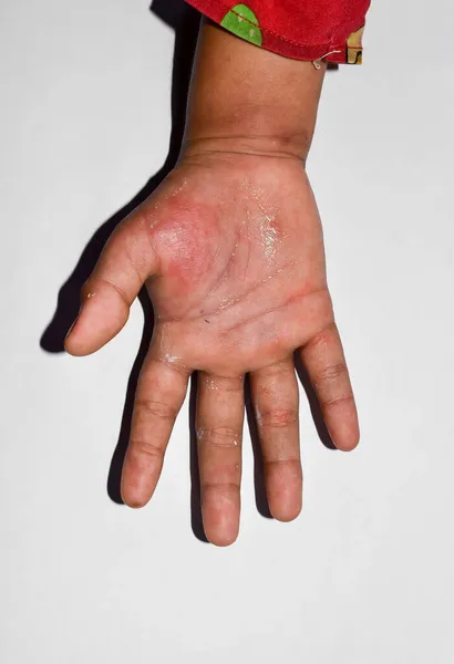 Edema Unilateral Com Sarna Membro Superior Mão Inchada Braço Criança — Fotografia de Stock