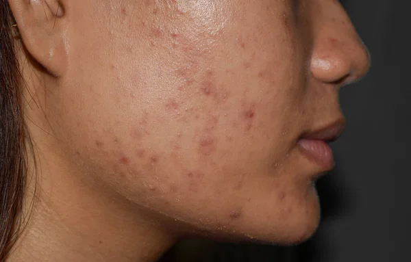 Acne , black spots and scars on face of Asian young woman.