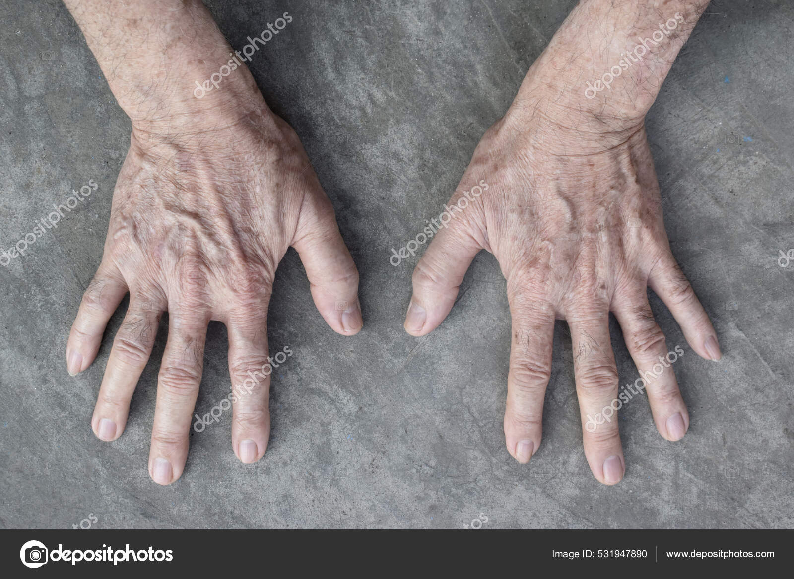 Age Spots Hands Asian Elder Man Brown Gray Black Spots Stock Photo By C Zaynyinyi